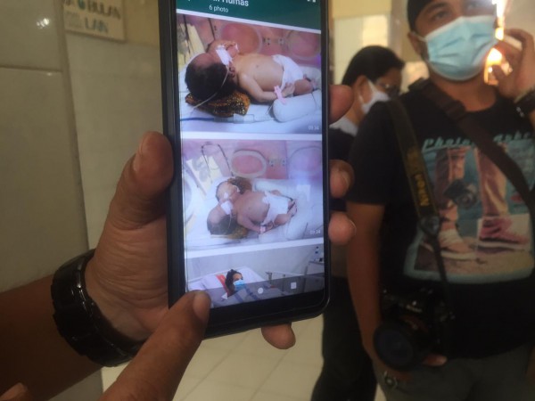 Bayi Kembar Siam Dua Kepala dengan Satu Tubuh Belum Stabil, Ibu Bayi: Selama Hamil Tak Terasa Aneh-aneh