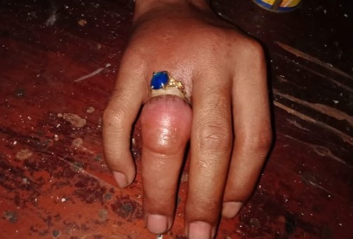Seminggu Tak Bisa Melepas Cincin di Jarinya, Pemuda di Tangerang Minta Bantuan BPBD
