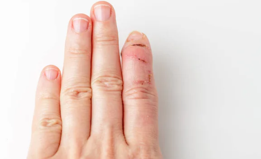 Terungkap! Ini Arti Mitos Bekas Luka di Telunjuk Kiri, Pertanda Apa?