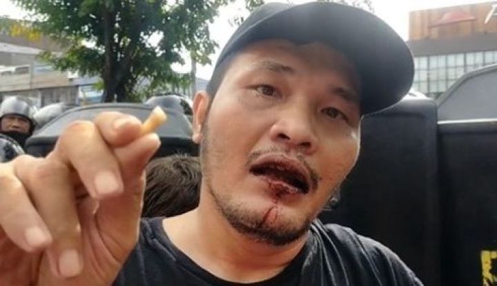 Unggah Video Mulut Berdarah dan Giginya Copot, Nicho Silalahi Malah Diejek Para BuzzerRp