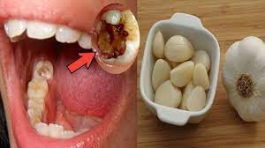 Panduan Efektif Mengobati Gigi Berlubang dengan Metode Alami
