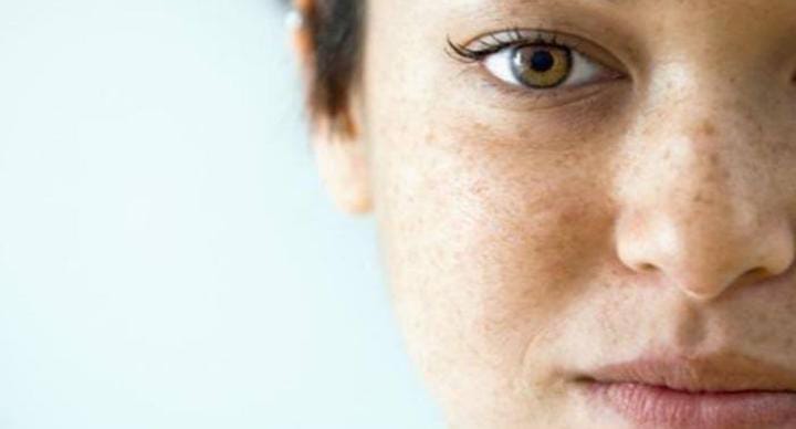 5 Penyebab Munculnya Flek Hitam di Wajah yang Dapat Menganggu Penampilan 