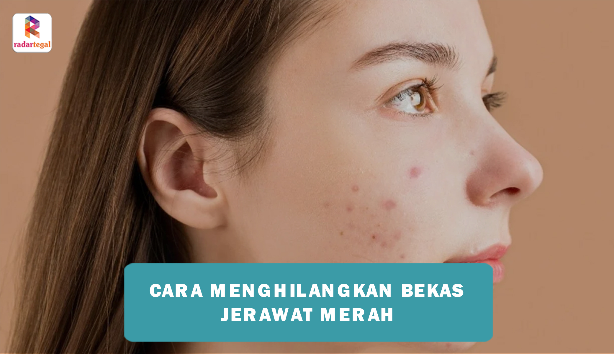 Cara Menghilangkan Bekas Jerawat Merah Secara Alami dan Medis, Terbukti Ampuh dan Efektif!