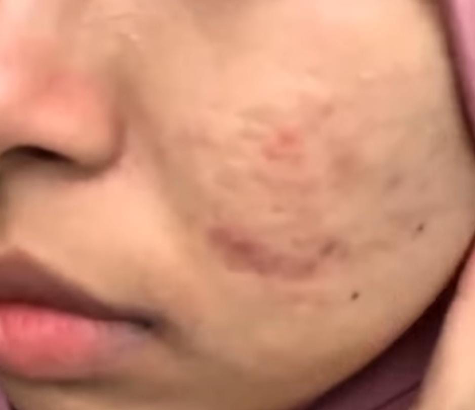 Pori Besar, Minyak Berlebih, dan Kulit Cepat Kusam? AGB dengan Niacinamide 8% & Bakuchiol Bisa Jadi Jawabannya