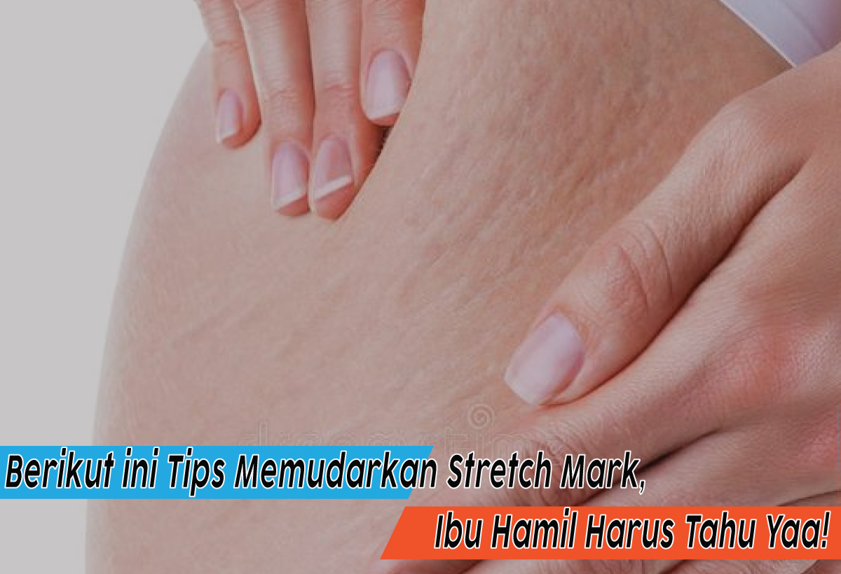 Tips Memudarkan Stretch Mark, Rahasia Mengembalikan Kecantikan Kulit