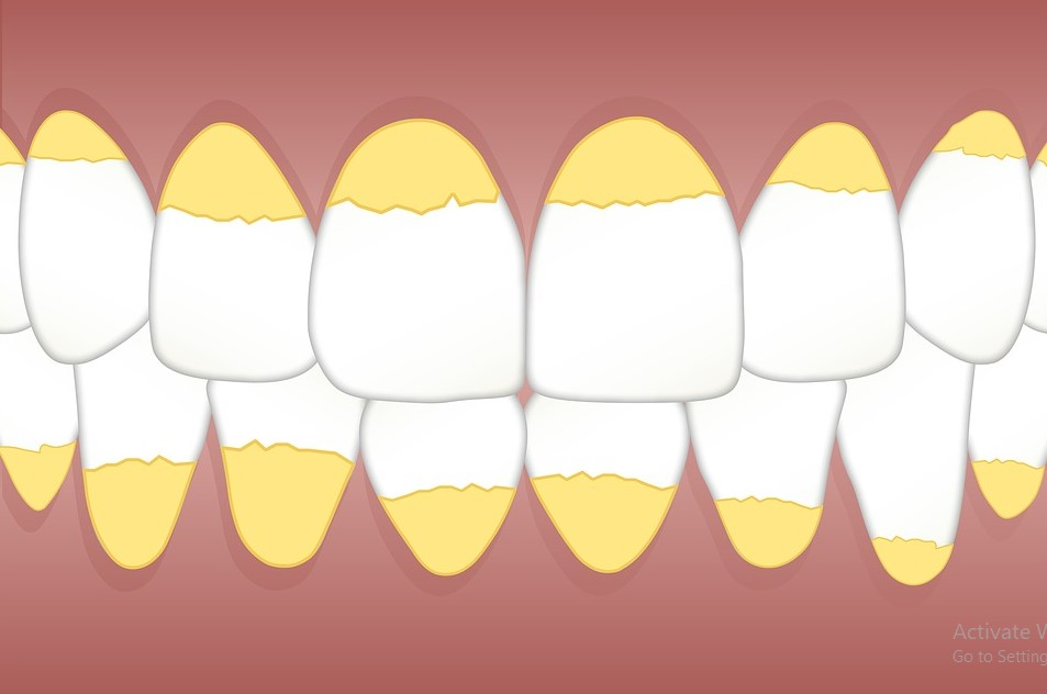 Bersihkan Karang Gigi dengan Mudah: Cara Alami dan Efektif untuk Menjaga Kesehatan Gigi