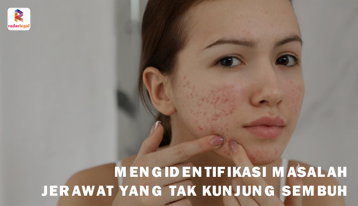 Jerawat Tak Kunjung Sembuh? Jangan-Jangan Kamu Terkena Skin Picking Disorder