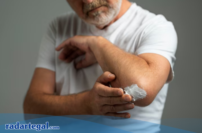 Jangan Sembarangan! Ini Fakta dan Mitos Mengoleskan Pasta Gigi pada Luka Bakar