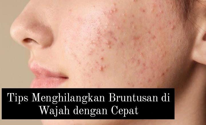 Tips Menghilangkan Bruntusan dengan Cepat dan Efektif Tanpa Iritasi Cuma Dalam Seminggu