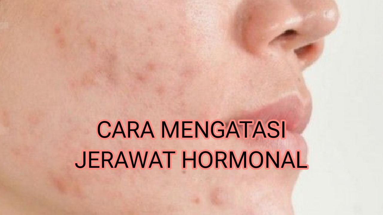 4 Cara Mengatasi Jerawat Hormonal, Tidur Berkualitas Salah Satunya