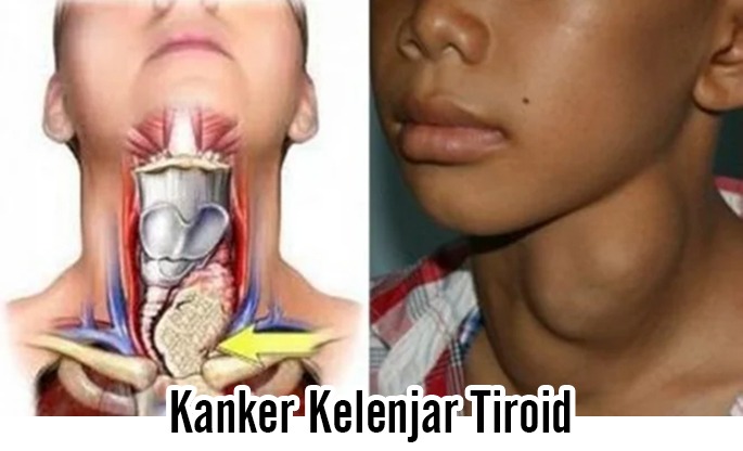 Mengenal Kanker Kelenjar Tiroid