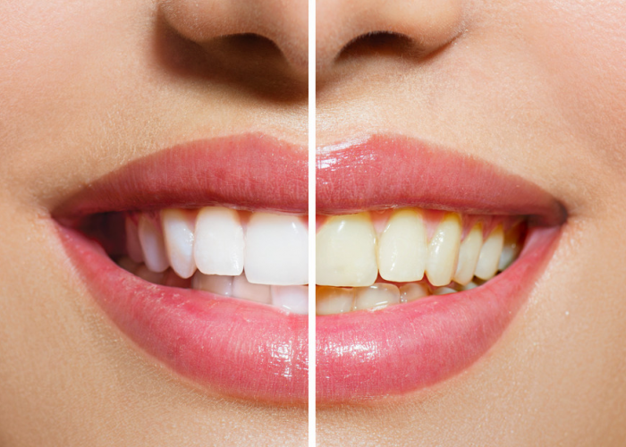 Terbukti, Ini Tips Membuat Gigi Putih Berseri Secara Alami