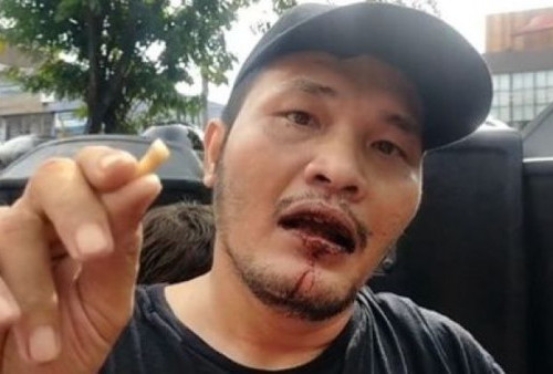Unggah Video Mulut Berdarah dan Giginya Copot, Nicho Silalahi Malah Diejek Para BuzzerRp
