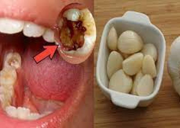 Panduan Efektif Mengobati Gigi Berlubang dengan Metode Alami