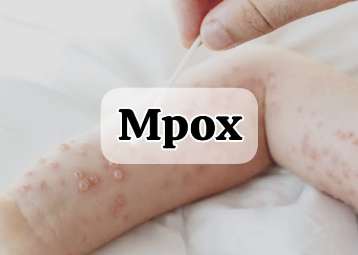 Pasien Mpox Meninggal Dunia di RSCM, Total Kasus Capai 57 Orang