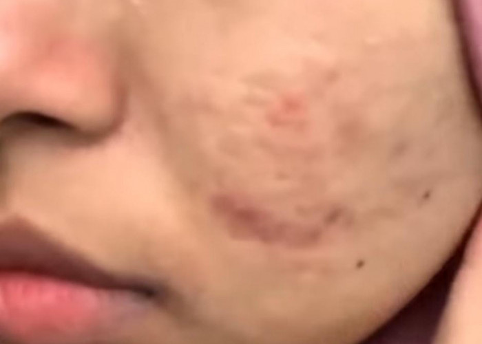 Pori Besar, Minyak Berlebih, dan Kulit Cepat Kusam? AGB dengan Niacinamide 8% & Bakuchiol Bisa Jadi Jawabannya