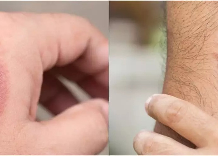 Kulit Belang Lenyap Super Cepat, Ini 10 Rekomendasi Hand Body untuk Menghilangkan Bekas Luka yang Efektif