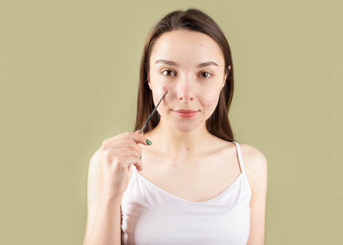 5 Kandungan Skincare untuk Menghilangkan Bopeng Terbaik yang Pasti Ampuh