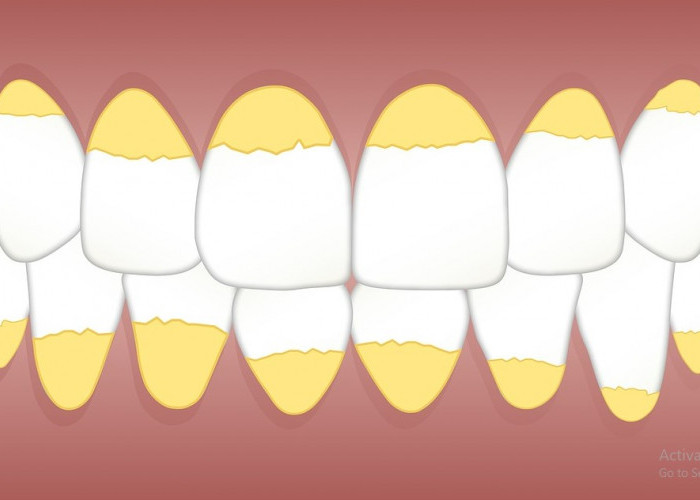 Bersihkan Karang Gigi dengan Mudah: Cara Alami dan Efektif untuk Menjaga Kesehatan Gigi
