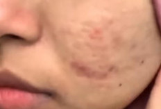 Pori Besar, Minyak Berlebih, dan Kulit Cepat Kusam? AGB dengan Niacinamide 8% & Bakuchiol Bisa Jadi Jawabannya